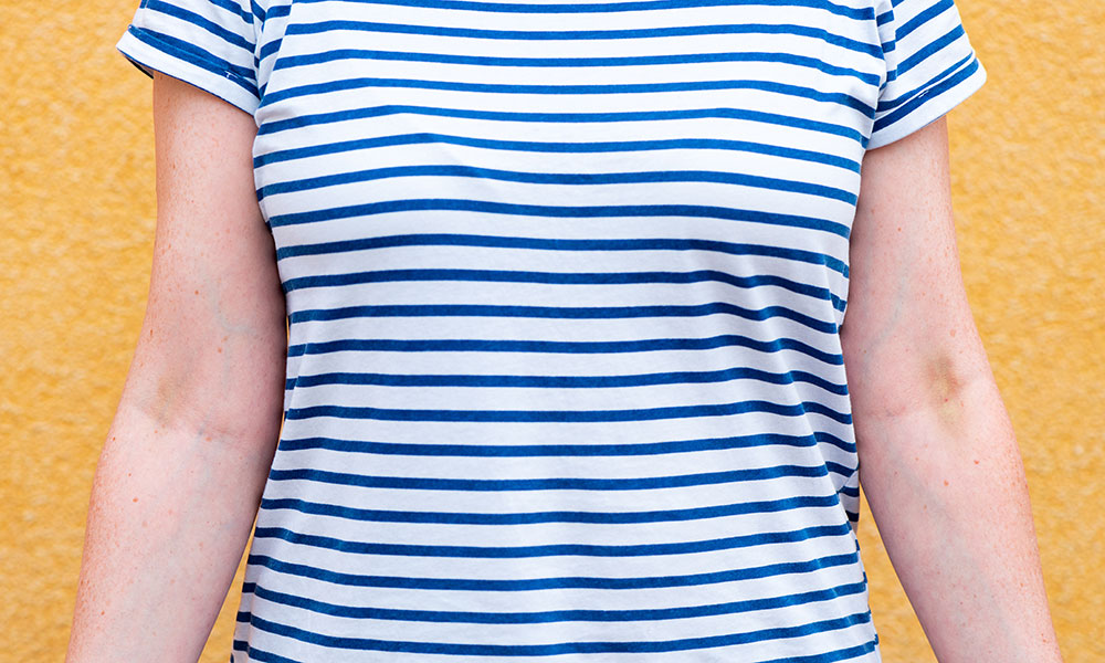  Track marks can lead to abscesses, skin infections, and other lesions from repeated injections. 